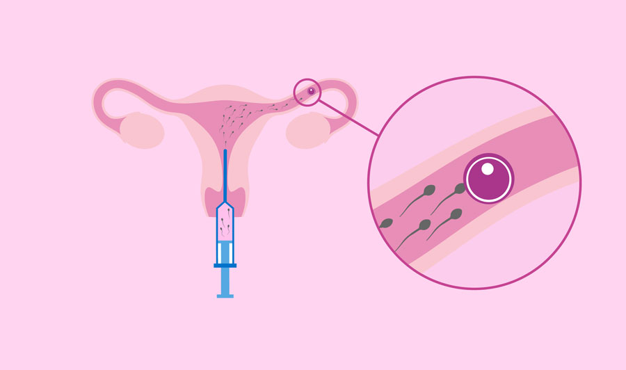 Artificial Insemination Homologous - Miracle IVF Hospital, Bangalore.