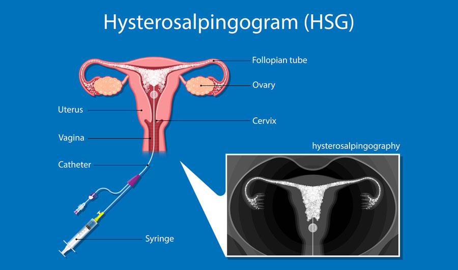 Hysterosalpingography (HSG) Procedure at Miracle IVF Hospital, Bangalore.